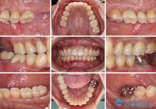 治療中放置してしまった奥歯 セラミック治療の治療後