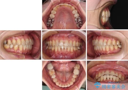 インビザラインは面倒くさい 目立たないワイヤー装置による矯正治療の治療後