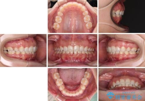 口がしっかりと閉じられない ワイヤー装置での抜歯矯正で出っ歯を改善の治療後