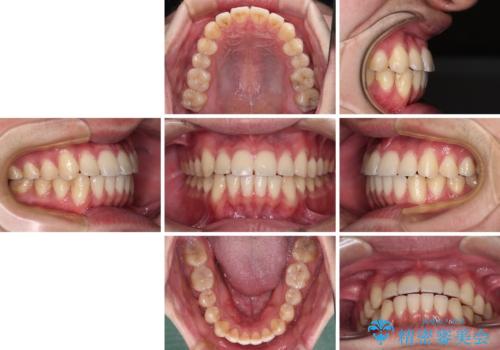 八重歯と前歯のクロスバイト ワイヤー装置で短期間矯正の治療後