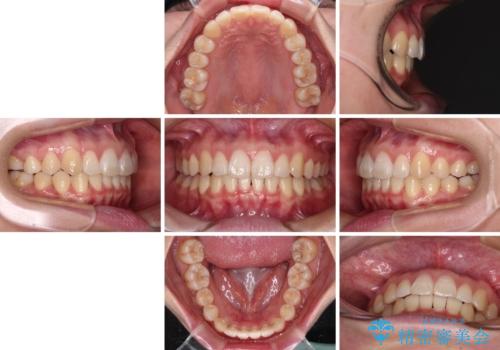 【モニター】すきっ歯をインビザラインで解消の治療後