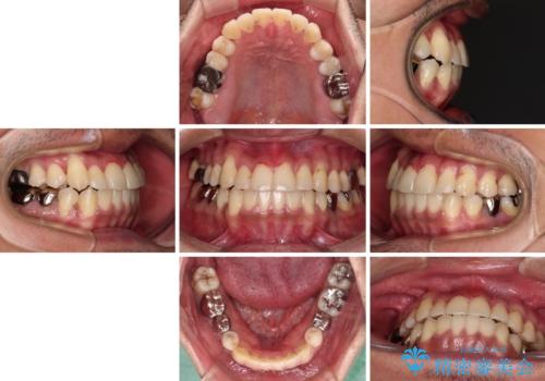 前歯のクロスバイトを改善　インビザライン矯正の治療後