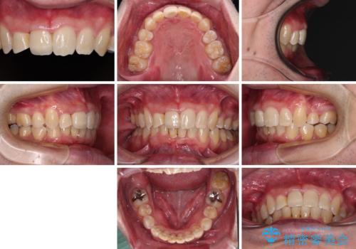 前歯が折れたついでに歯並びも改善 矯正治療と前歯のセラミック治療の治療後