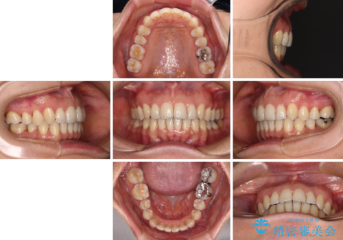 矯正治療の後戻り インビザライン・ライトによる矯正治療の治療後
