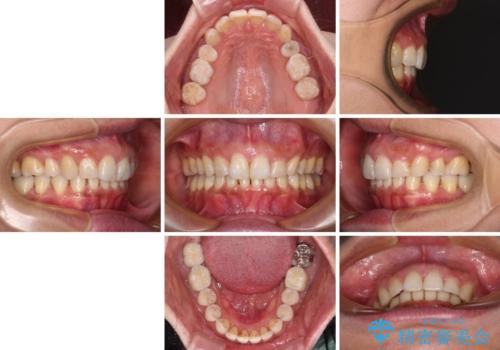 抜歯矯正の後戻りでできたスペース インビザライン矯正とセラミック治療の治療後