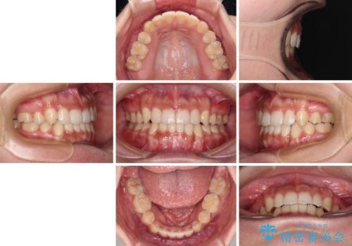 著しい八重歯が気になる インビザラインでの矯正治療の治療後