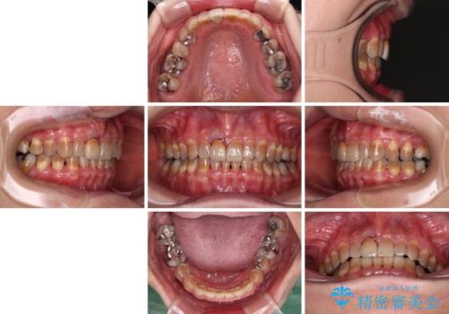 咬み合わせを治したい インビザラインによる矯正治療の治療後