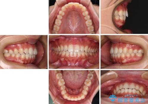 インビザラインを用いた上顎の部分矯正の治療後