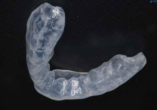 筋トレ時の歯を守るスポーツ用マウスガードの治療中