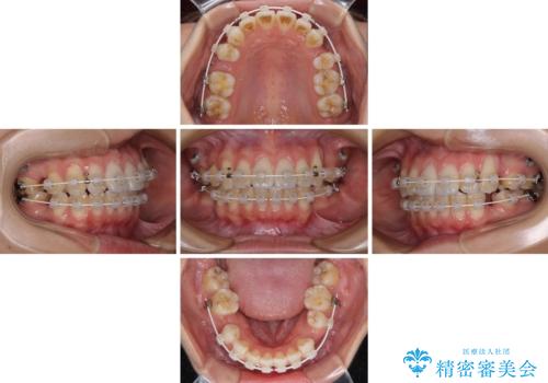 【モニター】気になる八重歯を素早く改善 ワイヤー装置での抜歯矯正の治療中