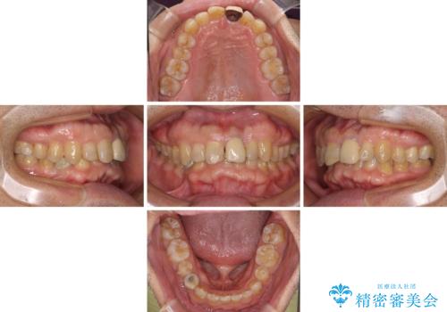 欠損歯列の矯正治療とインプラント治療の治療中