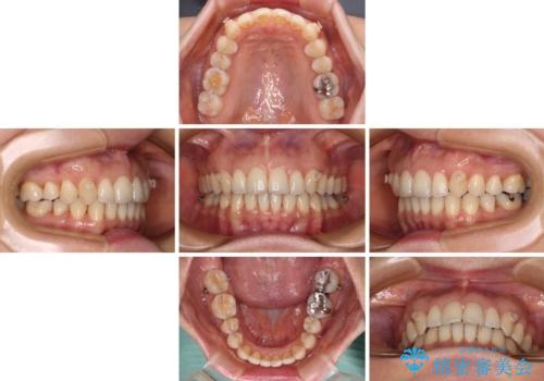 矯正治療の後戻り インビザライン・ライトによる矯正治療の治療中