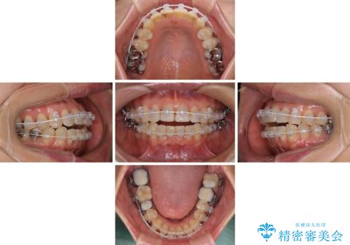 インビザラインは面倒くさい 目立たないワイヤー装置による矯正治療の治療中