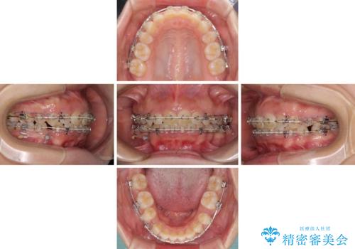 口がしっかりと閉じられない ワイヤー装置での抜歯矯正で出っ歯を改善の治療中