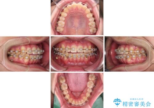 八重歯と前歯のクロスバイト ワイヤー装置で短期間矯正の治療中