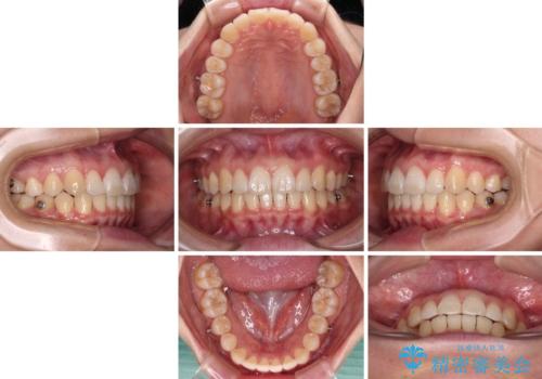 【モニター】すきっ歯をインビザラインで解消の治療中