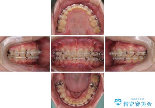 前歯が折れたついでに歯並びも改善　矯正治療と前歯のセラミック治療の治療中
