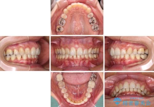 抜歯矯正の後戻りでできたスペース インビザライン矯正とセラミック治療の治療中