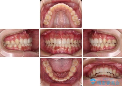 著しい八重歯が気になる インビザラインでの矯正治療の治療中