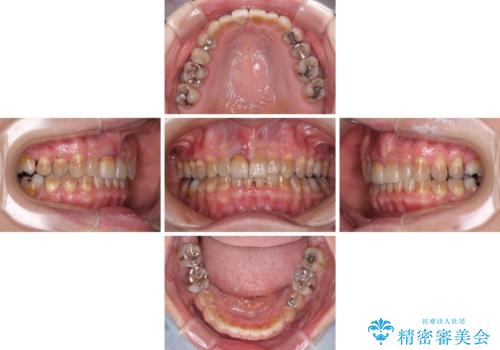 咬み合わせを治したい インビザラインによる矯正治療の治療中