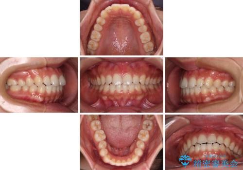 インビザラインを用いた上顎の部分矯正の治療中