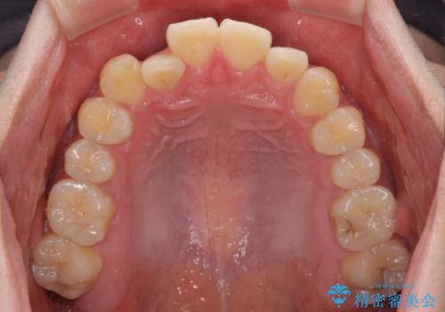 八重歯と前歯のクロスバイト ワイヤー装置で短期間矯正の治療前