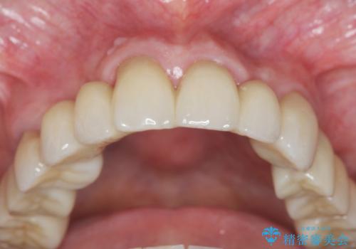 [ 前歯のオールセラミックブリッジ ]  前歯の腫れ・痛み・ニオイ・出血が気になるの治療後