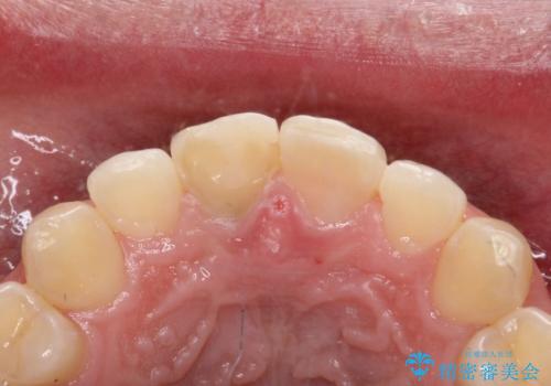 【ホワイトニング】右上前歯の歯茎の辺りが暗いのが気になる。の治療前