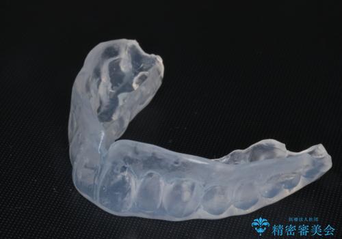 筋トレ時の歯を守るスポーツ用マウスガード