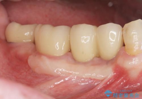 [ 臼歯部インプラント治療 ]   抜けた歯を治療したいの症例 治療後