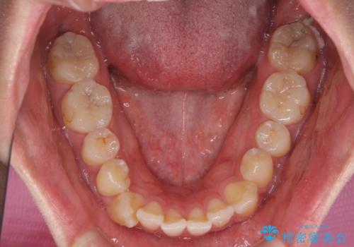 八重歯と前歯のクロスバイト ワイヤー装置で短期間矯正の治療前