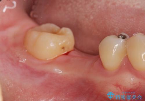 放置した虫歯 インプラントによる機能回復の治療中