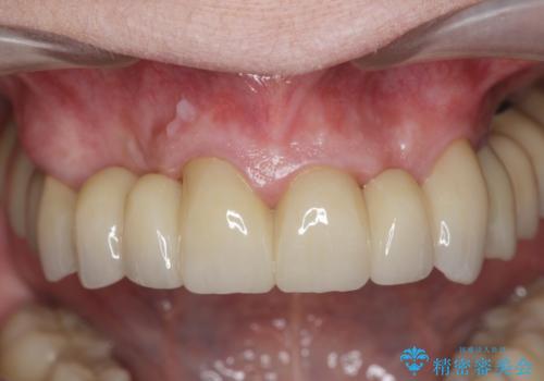 [ 前歯のオールセラミックブリッジ ]  前歯の腫れ・痛み・ニオイ・出血が気になるの治療後