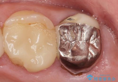 [ 2次カリエス ]クラウンのグラつき クラウン下の虫歯再発の症例 治療前