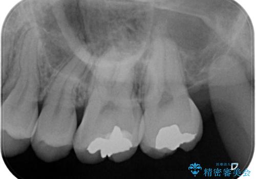目立つ銀歯を白くしたい セラミック治療の治療前