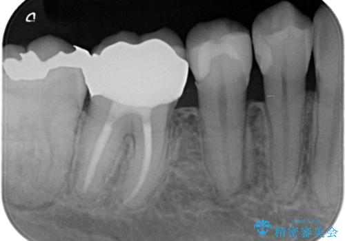 【オールセラミッククラウン】被せ物の治療の治療後