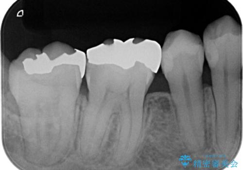 【オールセラミッククラウン】被せ物の治療の治療前