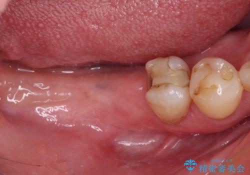憧れの白い歯に　全顎セラミック治療の治療中