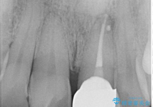 かけた前歯をきれいにしたいの治療後