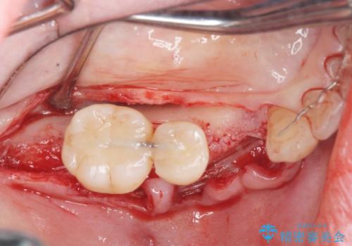 [ 臼歯部インプラント治療 ]   抜けた歯を治療したいの治療前