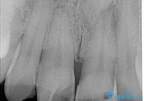 かけた前歯をきれいにしたいの治療前