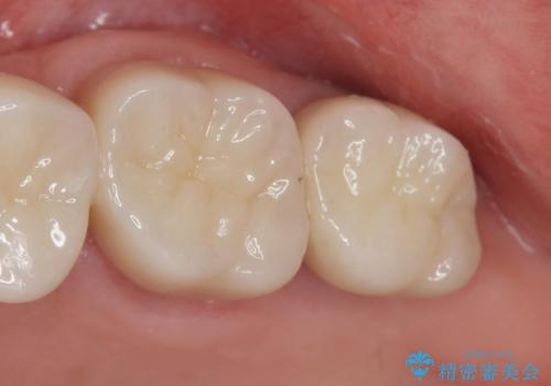 [ 2次カリエス ]クラウンのグラつき クラウン下の虫歯再発の症例 治療後