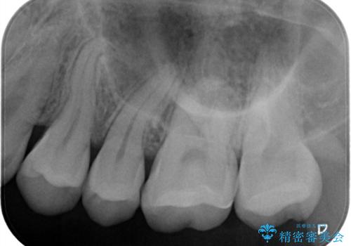 目立つ銀歯を白くしたい セラミック治療の治療後