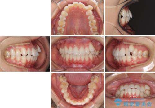 【モニター】気になる八重歯を素早く改善 ワイヤー装置での抜歯矯正の治療前