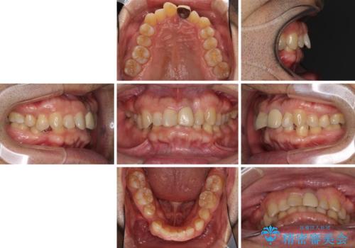 欠損歯列の矯正治療とインプラント治療の治療前