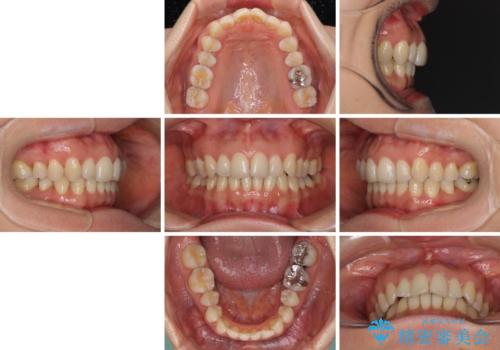 矯正治療の後戻り インビザライン・ライトによる矯正治療の治療前