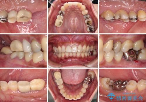 治療中放置してしまった奥歯 セラミック治療の治療前