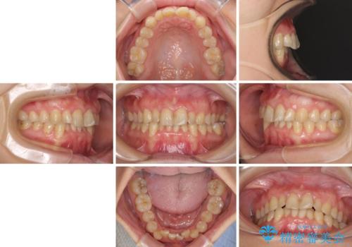前歯のデコボコと奥歯のクロスバイト　インビザラインで改善の治療前