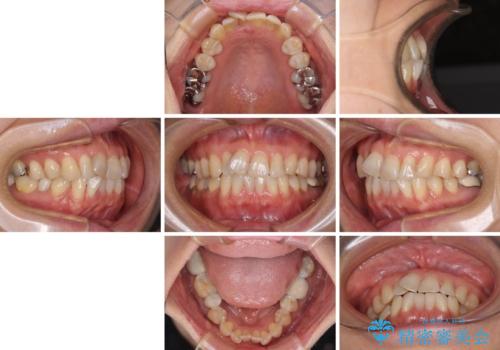 インビザラインは面倒くさい　目立たないワイヤー装置による矯正治療の治療前