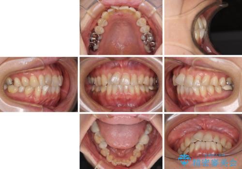 インビザラインは面倒くさい 目立たないワイヤー装置による矯正治療の治療前